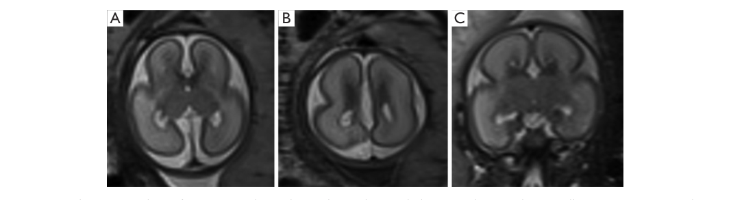 ## Context ID: pqac-00000053 The requested imaging findings and summary for ARX-related lissencephaly (XLAG) are captured in Figure 1, Figure 2, and Table 1. - 