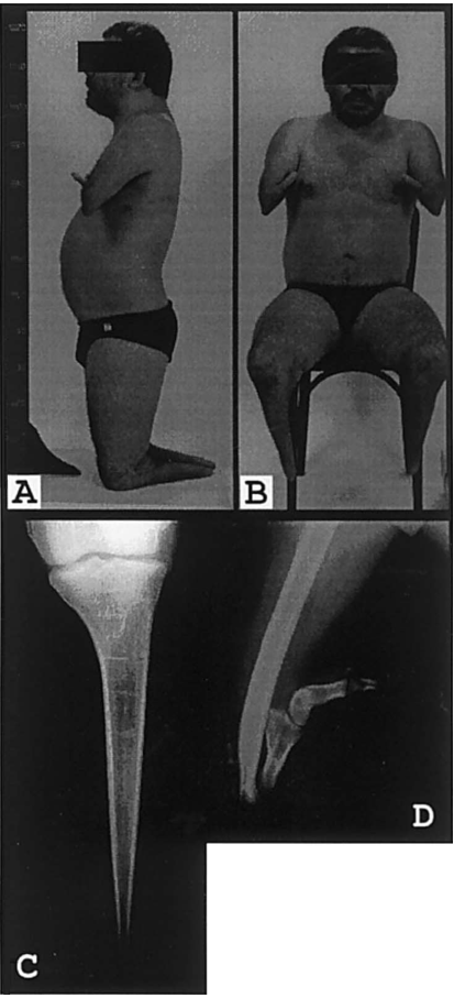 ## Context ID: pqac-00000026 Figure 2 illustrates the clinical and radiological features of acheiropodia in an affected individual. Panels A and B show the bila