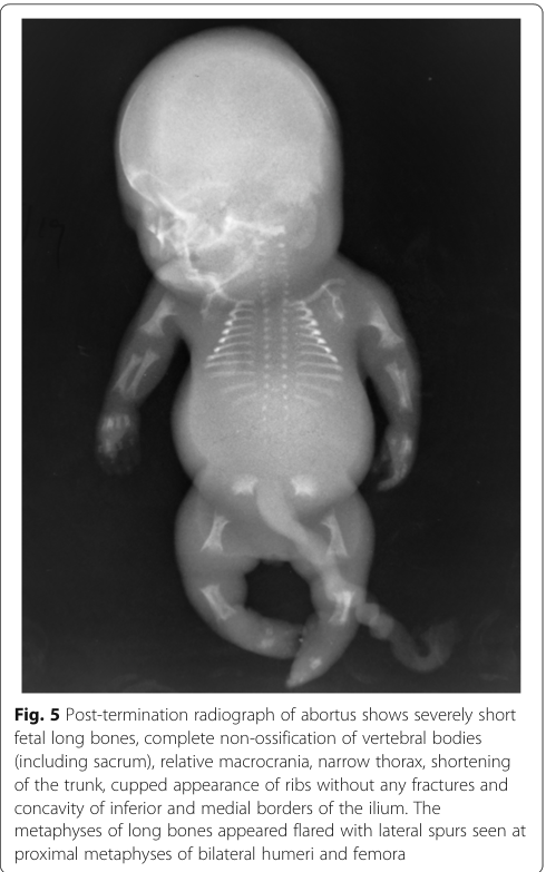 ## Context ID: pqac-00000008 The post-termination radiograph of the abortus in Figure 5 demonstrates the classic imaging findings of achondrogenesis type II. Th