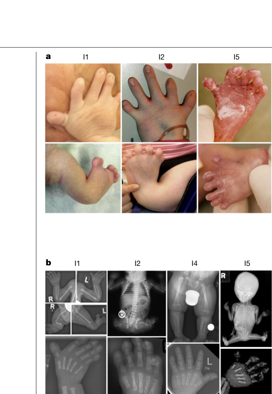 ## Context ID: pqac-00000014 The limb phenotype, HMGB1 tail frameshift schematic, and nucleolar localization for BPTAS are shown in several figures throughout t