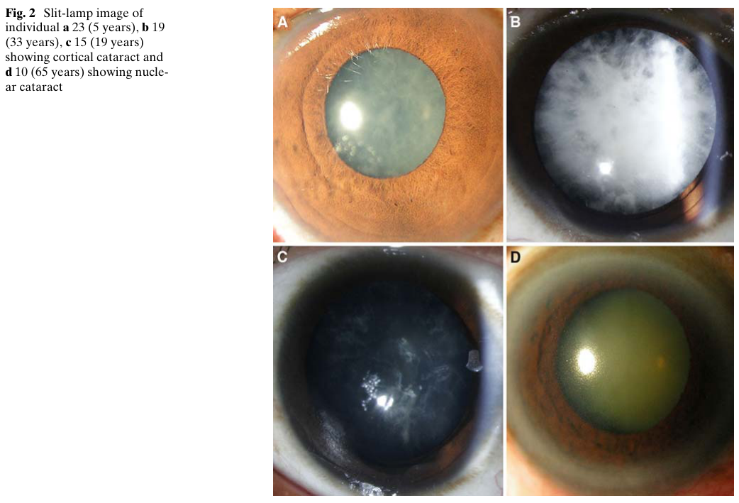 ## Context ID: pqac-00000015 The requested visual content has been extracted from the document. The first image shows Figure 2, which consists of slit-lamp phot