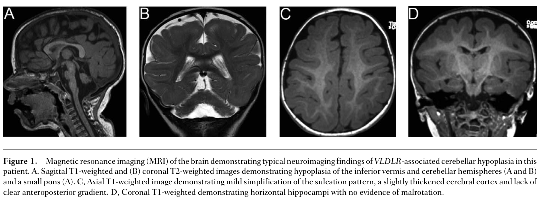 ## Context ID: pqac-00000017 The document provides several pieces of visual information regarding MRI findings and genetic variants for VLDLR-associated dysequi