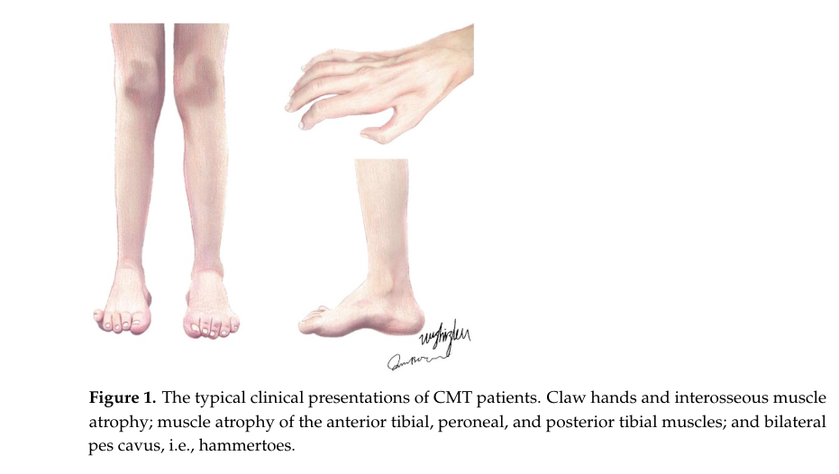 ## Context ID: pqac-00000021 The document includes both a figure illustrating the Charcot–Marie–Tooth (CMT) phenotype and a table for its electrophysiological c