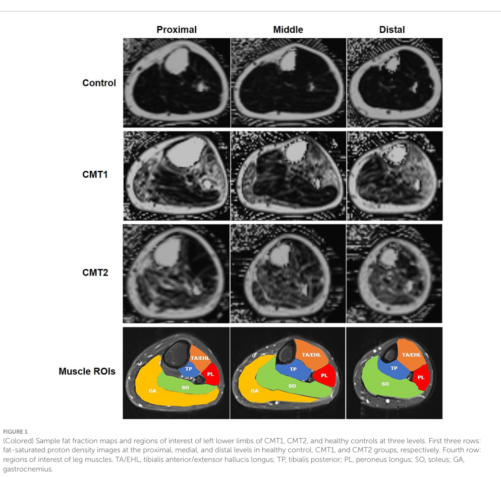## Context ID: pqac-00000025 I have extracted Figure 1, which displays the fat fraction maps and region of interest (ROI) definitions for calf muscles at three 