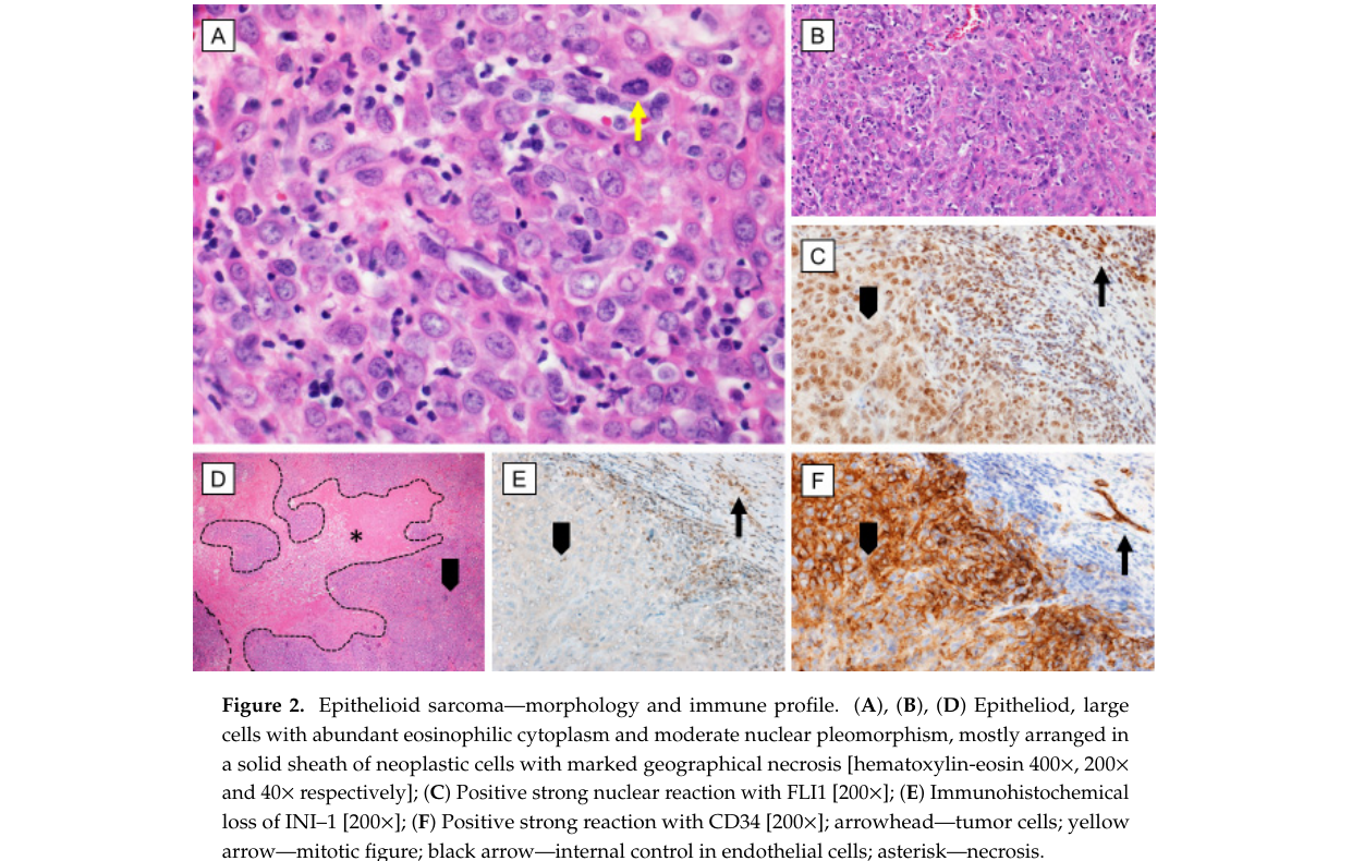 ## Context ID: pqac-00000052 Figure 2 on page 3 of the document illustrates the morphology and immune profile of epithelioid sarcoma. Panel E specifically demon