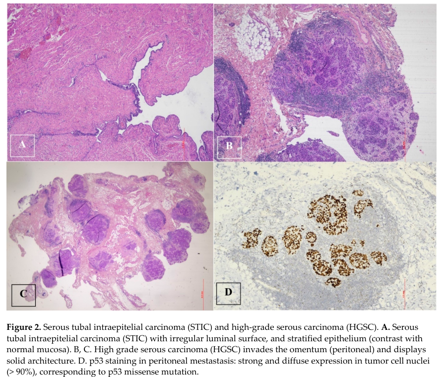 ## Context ID: pqac-00000032 The most relevant figure is Figure 2 on page 14, which illustrates the fallopian tube origin of high-grade serous carcinoma (HGSC)