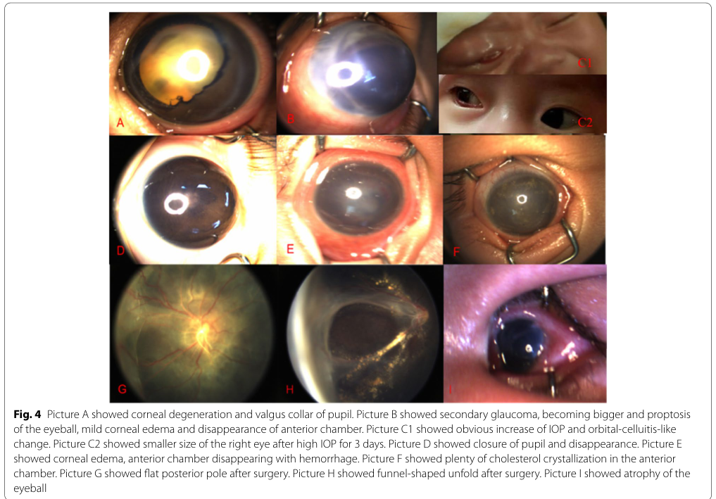 ## Context ID: pqac-00000008 The provided images summarize the clinical outcomes and prognosis for infant FEVR cases. Table 3 (image-013) details the surgical t
