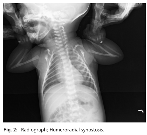 ## Context ID: pqac-00000025 The radiograph showing bilateral humeroradial synostosis is presented in Figure 2 on page 1 of the document.