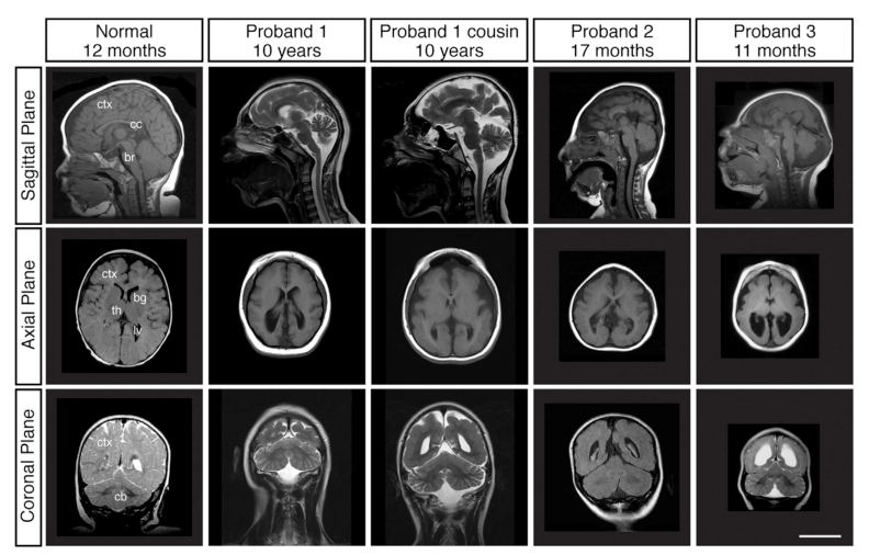 ## Context ID: pqac-00000034 The figure showing brain MRI and cortical malformation features in affected individuals is Figure 1A. It presents sagittal, axial, 