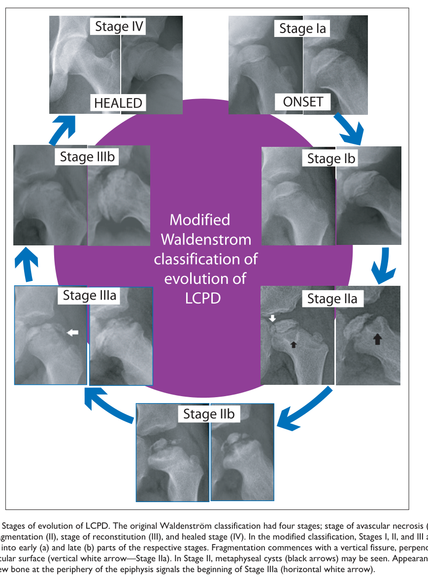 ## Context ID: pqac-00000032 Figure 4 illustrates the radiographic progression of Legg–Calvé–Perthes disease (LCPD) according to the modified Waldenström classi