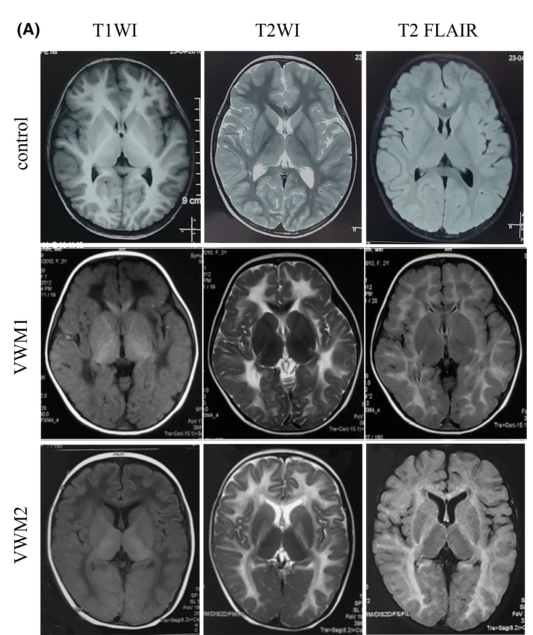 ## Context ID: pqac-00000019 Figure 1A on page 3 displays the MRI comparison between a normal control and two patients with vanishing white matter (VWM). The pa