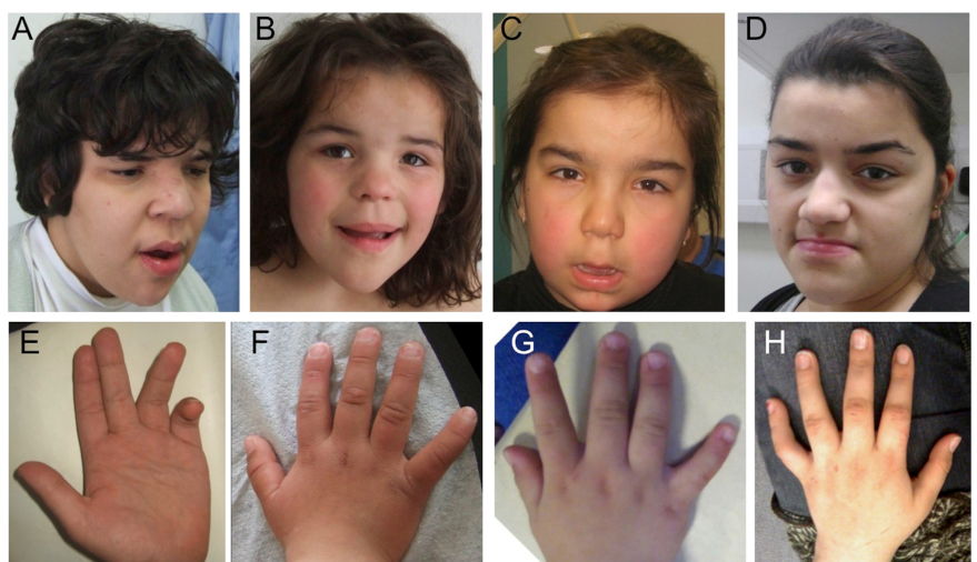 ## Context ID: pqac-00000020 Figure 1 presents phenotype photographs (A–H) and brain MRI scans (I–L and I'–L') of affected individuals. Panels I–K and I'–K' sho