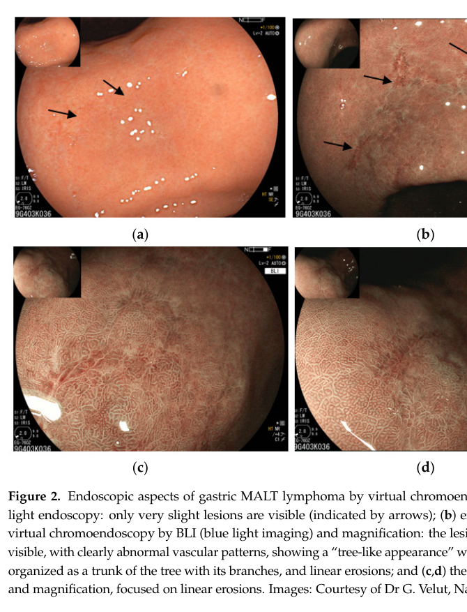 ## Context ID: pqac-00000028 The document provides endoscopic images of gastric MALT lymphoma across two figures. Figure 1 illustrates standard endoscopic appea
