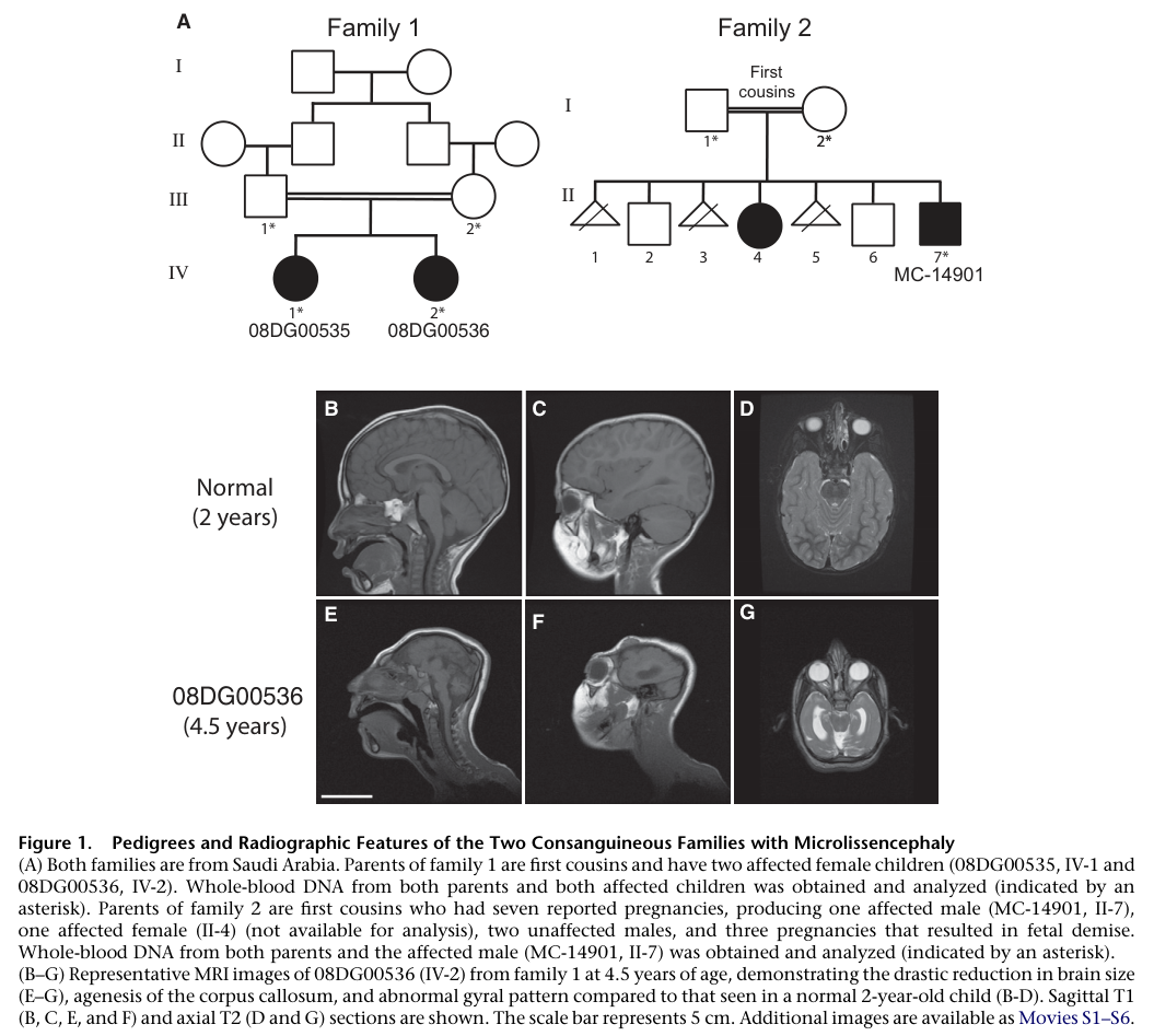 ## Context ID: pqac-00000024 Figure 1 from the document provides brain MRI images of an NDE1 patient (08DG00536) at 4.5 years of age (panels E, F, and G) compar