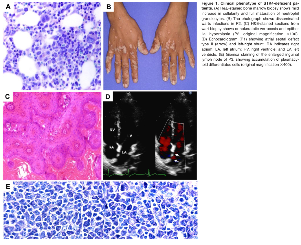 ## Context ID: pqac-00000009 Table 1, showing clinical and immunologic laboratory measurements including lymphocyte counts, is found on page 2. Figure 1 on page