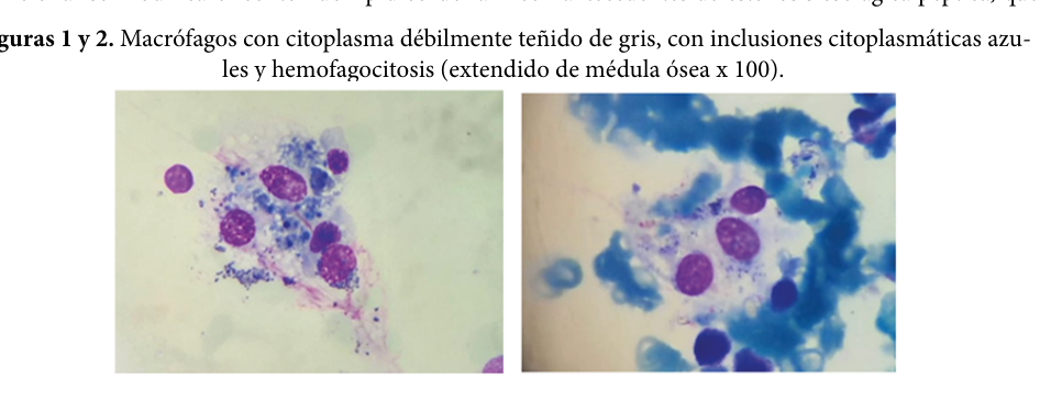 ## Context ID: pqac-00000022 The requested images of sea-blue histiocytes from the bone marrow aspirate and biopsy are found in Figures 1-2 and Figures 5-6 on p