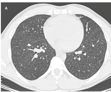 ## Context ID: pqac-00000051 The provided image is a tightly cropped version of Figure 7 panel A, showing a chest HRCT of a patient with talc granulomatosis cha